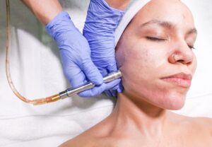 How to Fix Hormonal Acne Without Medication: 6 Luxury Skincare Solutions That Work