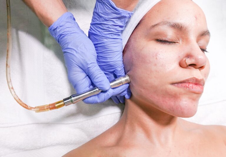 How to Fix Hormonal Acne Without Medication: 6 Luxury Skincare Solutions That Work